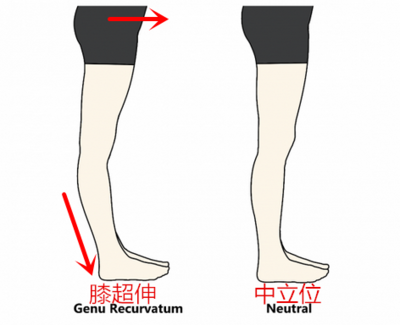 【膝超伸示意图】