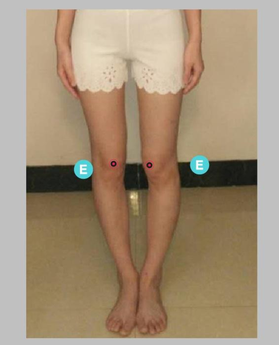 【O型腿示意图】