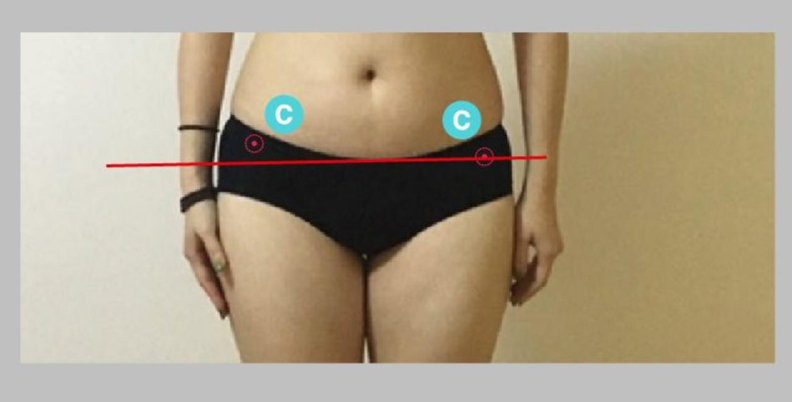 【骨盆侧倾示意图】