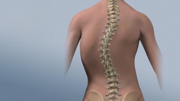 【脊柱侧弯示意图】