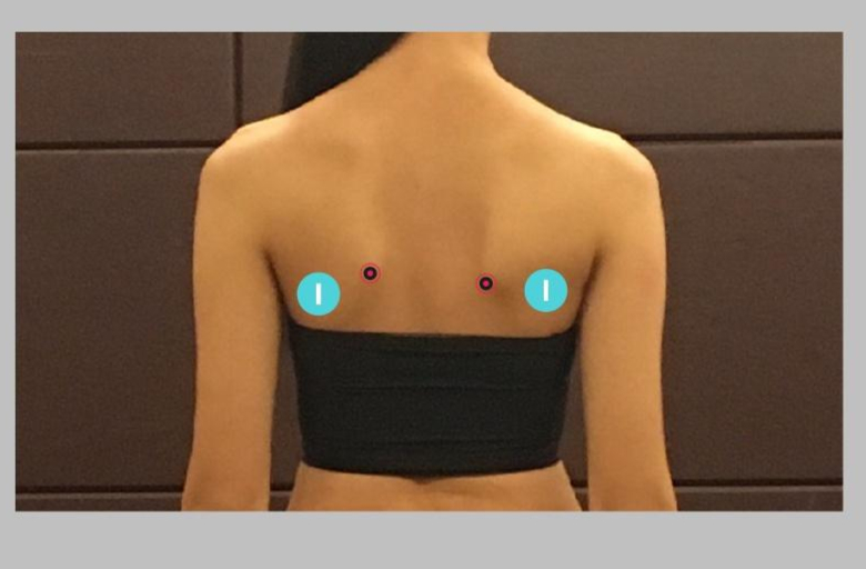 【翼状肩胛示意图】