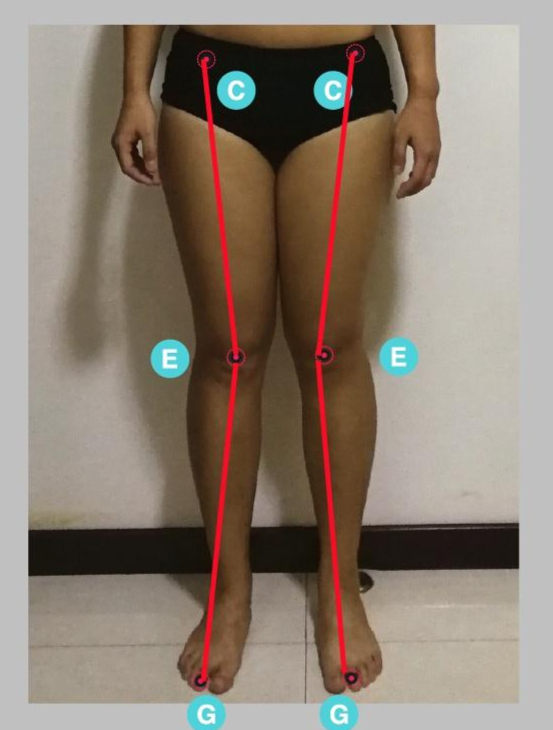 【X型腿示意图】